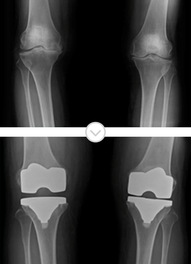 무릎 인공관절 치환